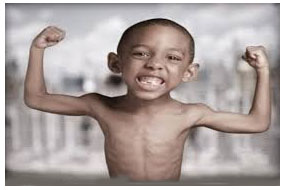 benh coi xuong o tre