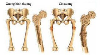 Bệnh còi xương ở trẻ em