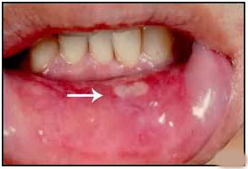 benh tua mieng o tr em